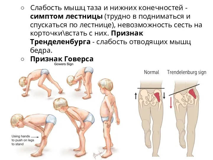 Слабость мышц таза и нижних конечностей - cимптом лестницы (трудно