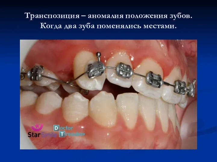 Транспозиция – аномалия положения зубов. Когда два зуба поменялись местами.