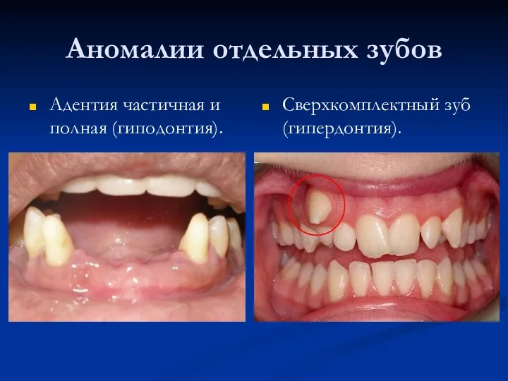 Аномалии отдельных зубов Адентия частичная и полная (гиподонтия). Сверхкомплектный зуб (гипердонтия).