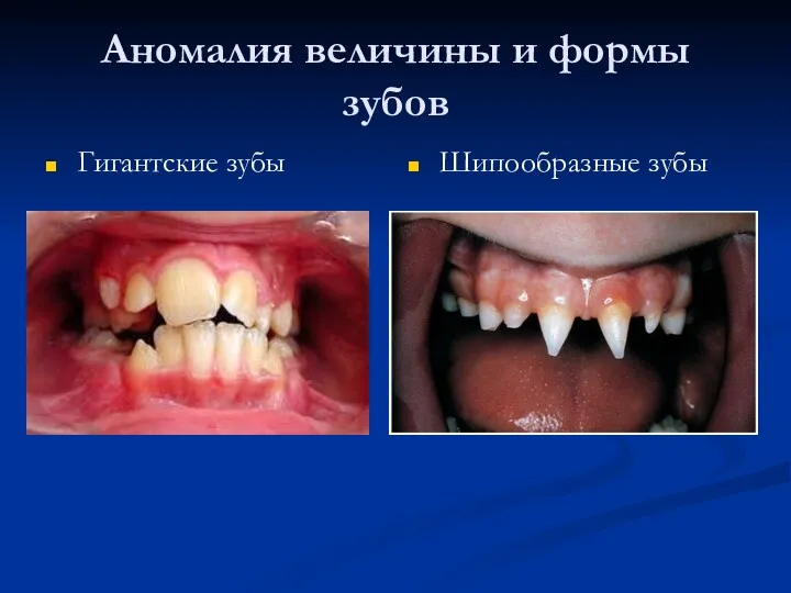 Аномалия величины и формы зубов Гигантские зубы Шипообразные зубы