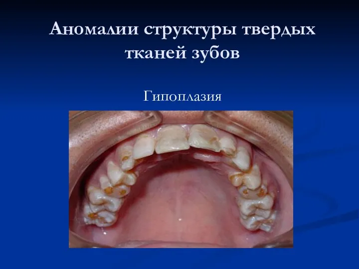 Аномалии структуры твердых тканей зубов Гипоплазия