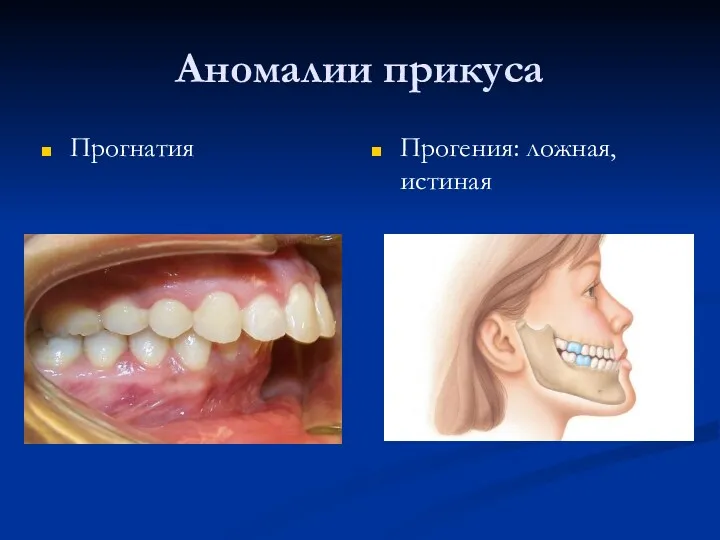 Аномалии прикуса Прогнатия Прогения: ложная, истиная