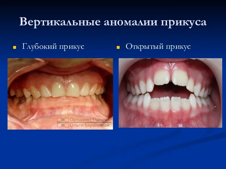 Вертикальные аномалии прикуса Глубокий прикус Открытый прикус