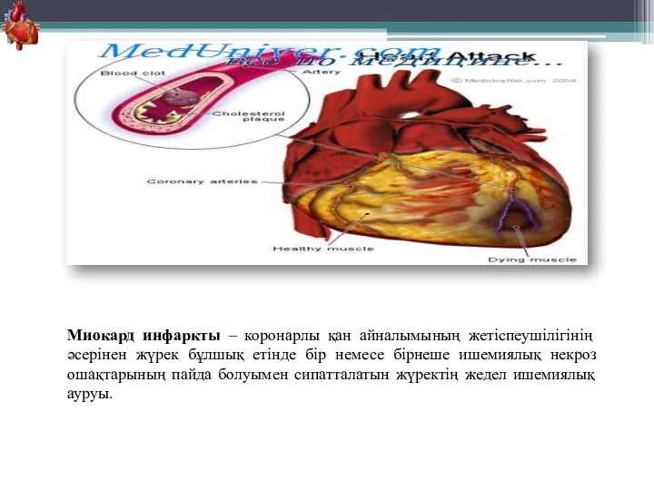 Миокард инфаркты – коронарлы қан айналымының жетіспеушілігінің әсерінен жүрек бұлшық