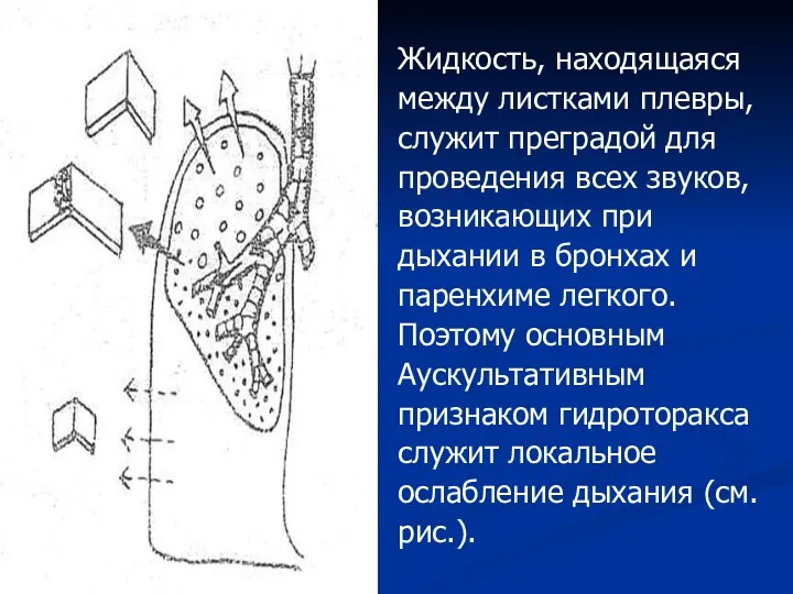 Жидкость, находящаяся между листками плевры, служит преградой для проведения всех