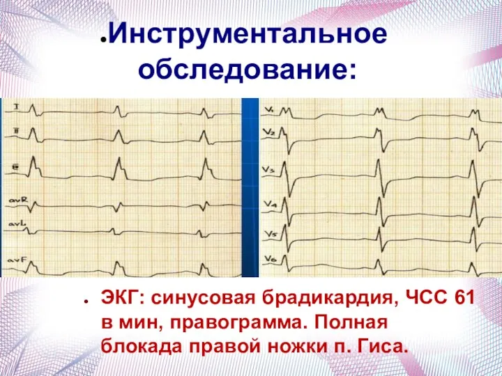 Инструментальное обследование: ЭКГ: синусовая брадикардия, ЧСС 61 в мин, правограмма. Полная блокада правой ножки п. Гиса.