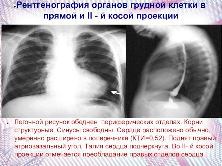 Рентгенография органов грудной клетки в прямой и II - й