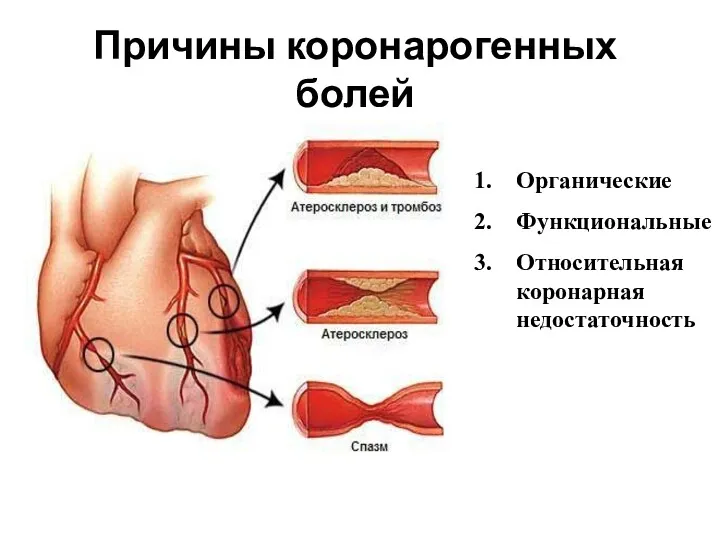 Причины коронарогенных болей Органические Функциональные Относительная коронарная недостаточность