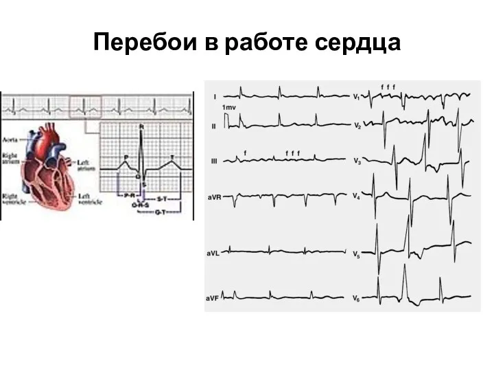 Перебои в работе сердца