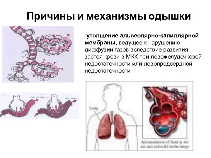 Причины и механизмы одышки утолщение альвеолярно-капиллярной мембраны, ведущее к нарушению диффузии газов вследствие