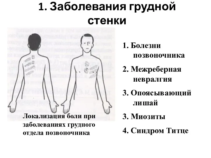 1. Заболевания грудной стенки Локализация боли при заболеваниях грудного отдела