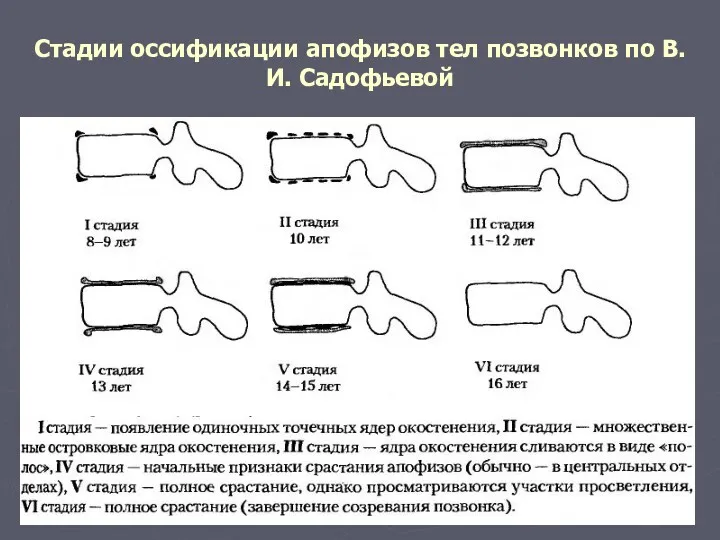 Стадии оссификации апофизов тел позвонков по В.И. Садофьевой