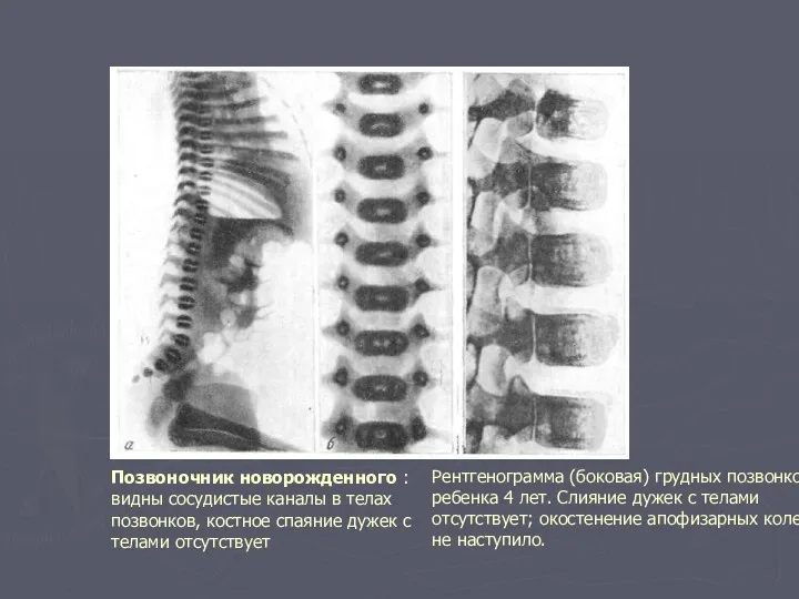 Позвоночник новорожденного :видны сосудистые каналы в телах позвонков, костное спаяние