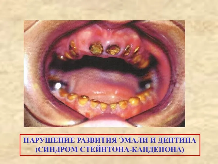 НАРУШЕНИЕ РАЗВИТИЯ ЭМАЛИ И ДЕНТИНА (СИНДРОМ СТЕЙНТОНА-КАПДЕПОНА)