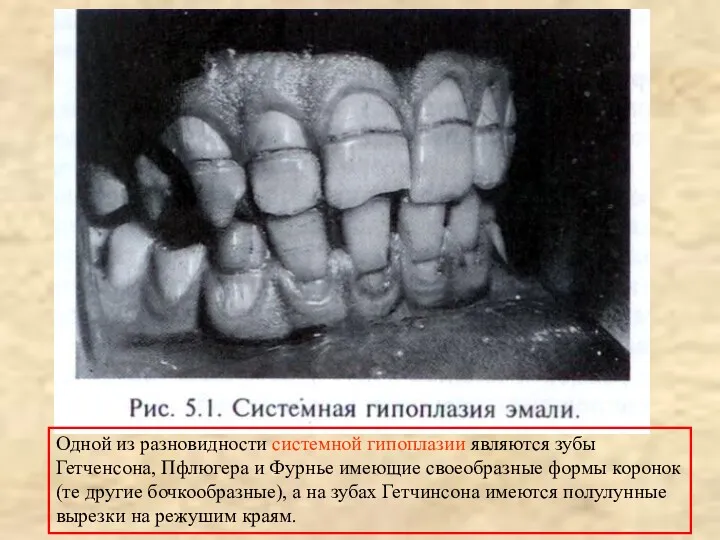 Одной из разновидности системной гипоплазии являются зубы Гетченсона, Пфлюгера и