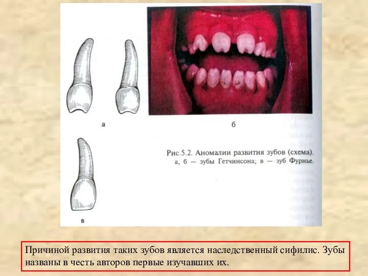 Причиной развития таких зубов является наследственный сифилис. Зубы названы в честь авторов первые изучавших их.