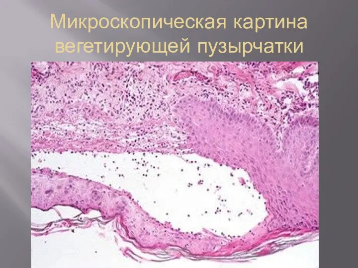 Микроскопическая картина вегетирующей пузырчатки
