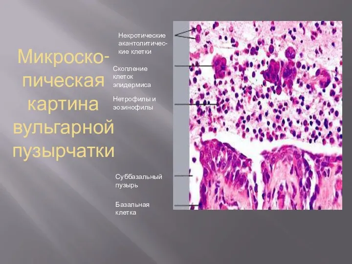Микроско-пическая картина вульгарной пузырчатки Некротические акантолитичес-кие клетки Скопление клеток эпидермиса