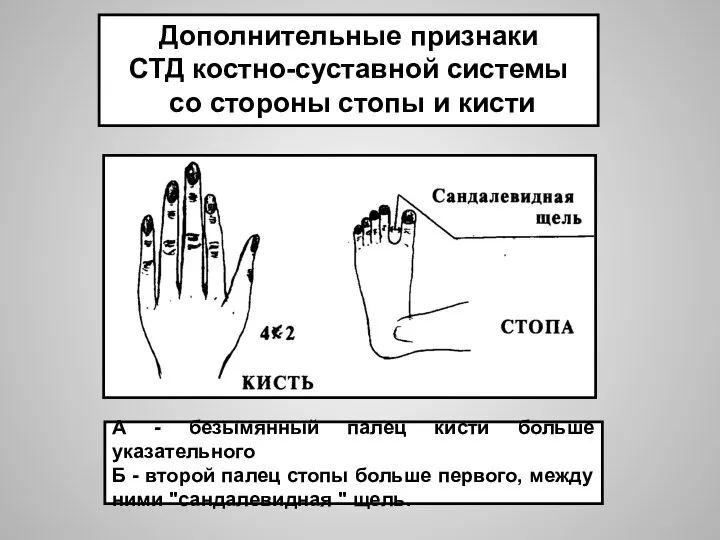 А - безымянный палец кисти больше указательного Б - второй