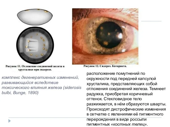 комплекс дегенеративных изменений, развивающийся вследствие токсического влияния железа (siderosis bulbi,