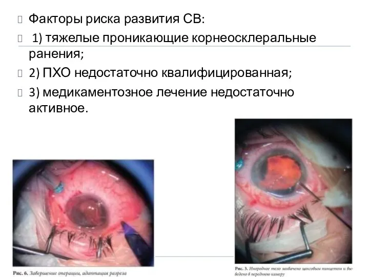 Факторы риска развития СВ: 1) тяжелые проникающие корнеосклеральные ранения; 2)