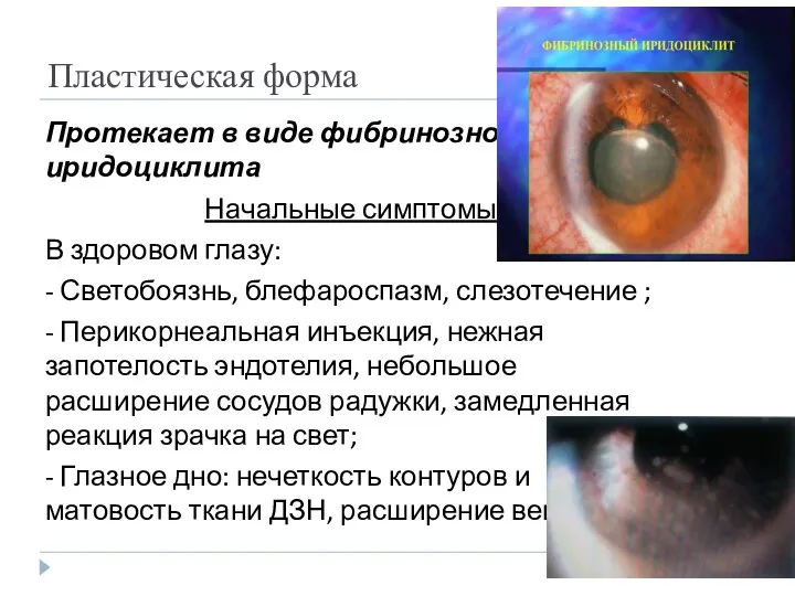 Пластическая форма Протекает в виде фибринозного иридоциклита Начальные симптомы: В