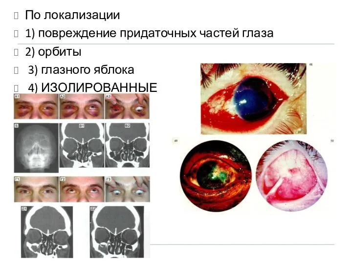 По локализации 1) повреждение придаточных частей глаза 2) орбиты 3) глазного яблока 4) ИЗОЛИРОВАННЫЕ