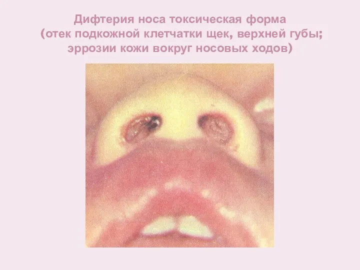 Дифтерия носа токсическая форма (отек подкожной клетчатки щек, верхней губы; эррозии кожи вокруг носовых ходов)
