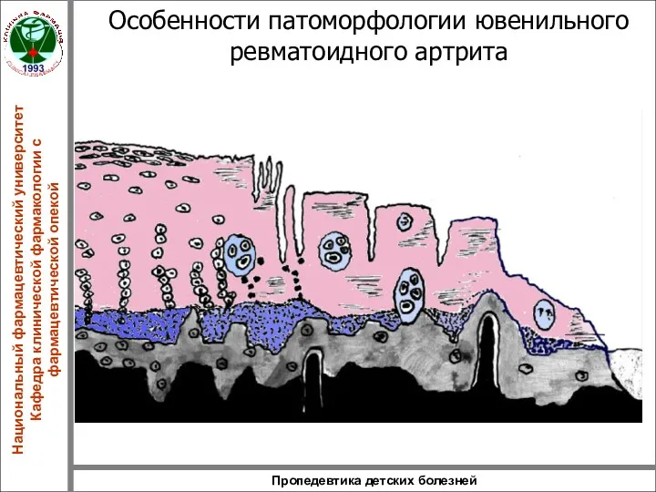 Пропедевтика детских болезней Особенности патоморфологии ювенильного ревматоидного артрита