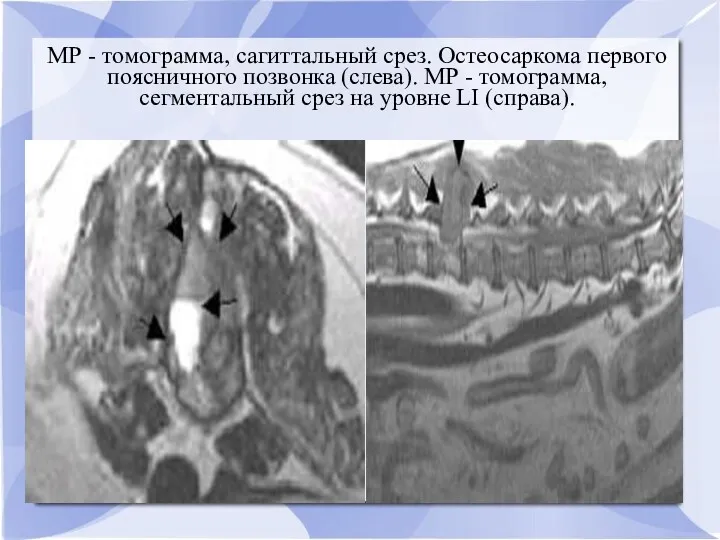 МР - томограмма, сагиттальный срез. Остеосаркома первого поясничного позвонка (слева).