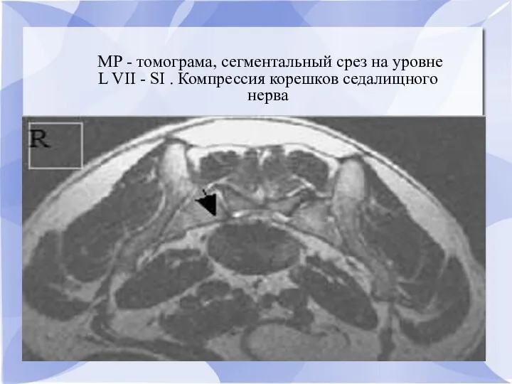 МР - томограма, сегментальный срез на уровне L VII - SI . Компрессия корешков седалищного нерва