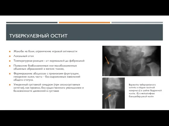 ТУБЕРКУЛЕЗНЫЙ ОСТИТ Жалобы на боли, ограничение игровой активности Локальный отек