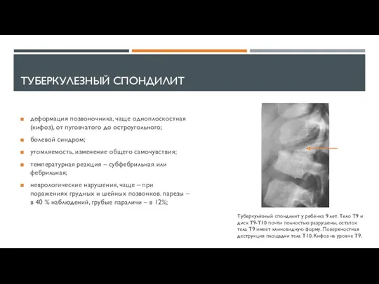 ТУБЕРКУЛЕЗНЫЙ СПОНДИЛИТ деформация позвоночника, чаще одноплоскостная (кифоз), от пуговчатого до