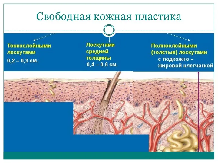 Свободная кожная пластика