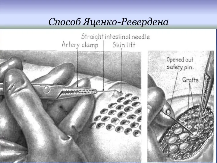 Способ Яценко-Ревердена