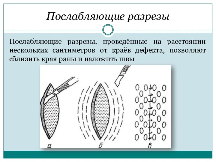 Послабляющие разрезы Послабляющие разрезы, проведённые на расстоянии нескольких сантиметров от