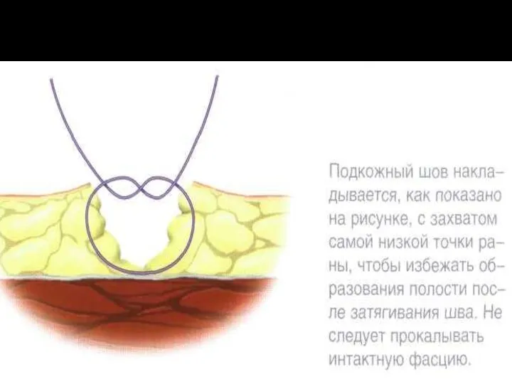 Простой узловой шов