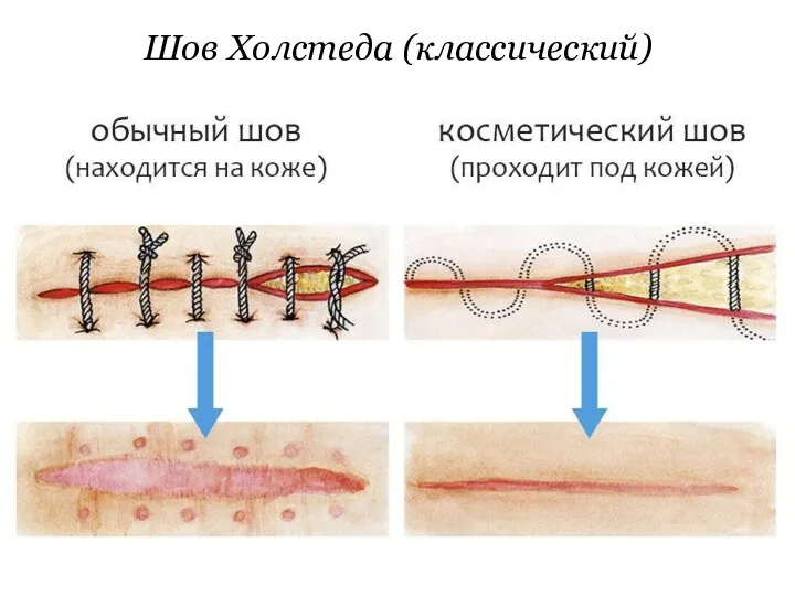 Шов Холстеда (классический)