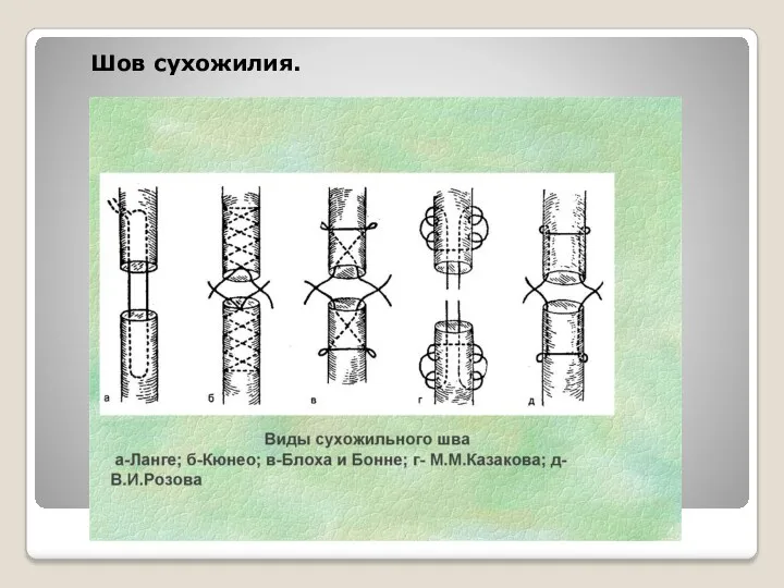 Шов сухожилия.