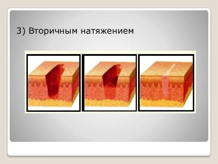 3) Вторичным натяжением