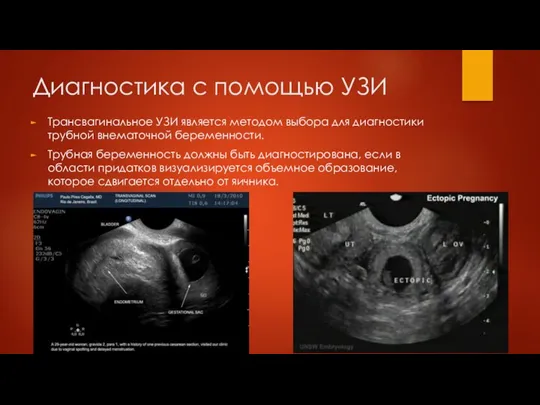 Диагностика с помощью УЗИ Трансвагинальное УЗИ является методом выбора для