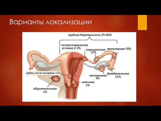 Варианты локализации