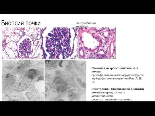 Биопсия почки Световая микроскопия биоптата почки: пролиферативный гломерулонефрит с нейтрофилами