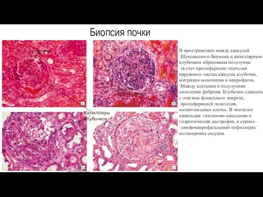 Биопсия почки В пространствах между капсулой Шумлянского-Боумена и капиллярным клубочком