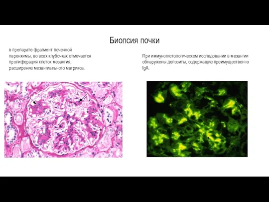 Биопсия почки в препарате фрагмент почечной паренхимы, во всех клубочках