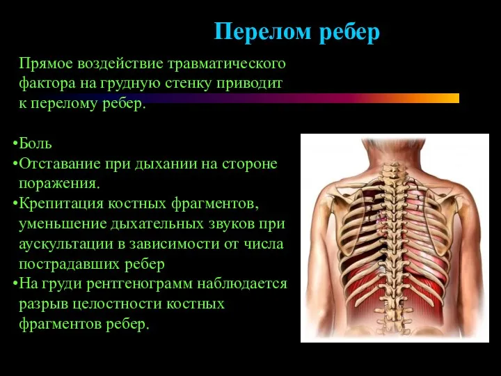 Прямое воздействие травматического фактора на грудную стенку приводит к перелому