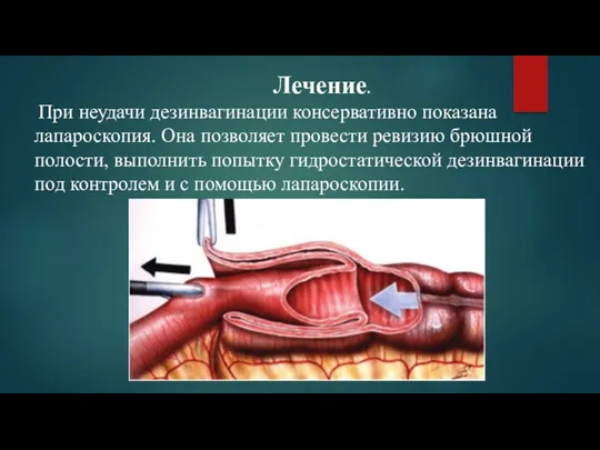 Лечение. При неудачи дезинвагинации консервативно показана лапароскопия. Она позволяет провести