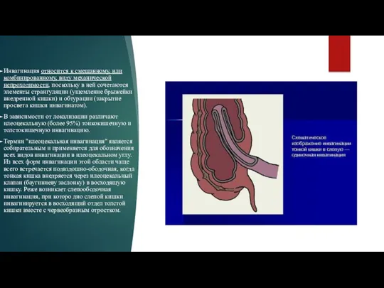 Инвагинация относится к смешанному, или комбинированному, виду механической непроходимости, поскольку