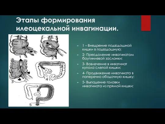 Этапы формирования илеоцекальной инвагинации. 1 – Внедрение подвздошной кишки в