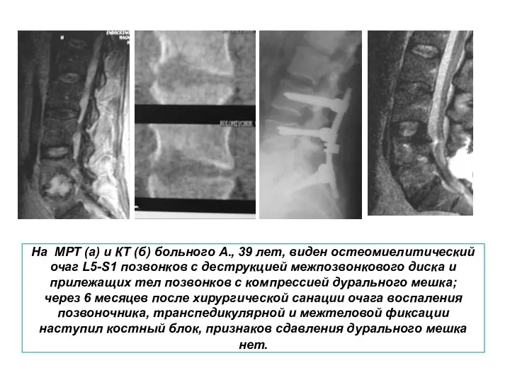 На МРТ (а) и КТ (б) больного А., 39 лет,